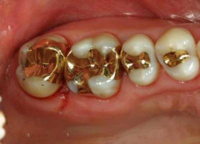علل پوسیدگی دندان و راهکارهای درمان آن