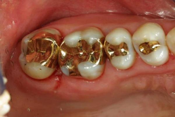 علل پوسیدگی دندان و راهکارهای درمان آن